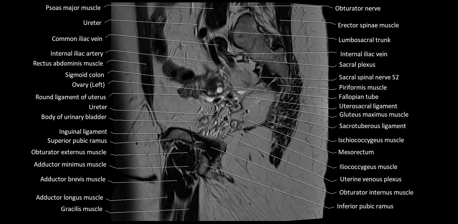 Sagittal cross sectional anatomy of female pelvis (MRI 3T) image 31.webp